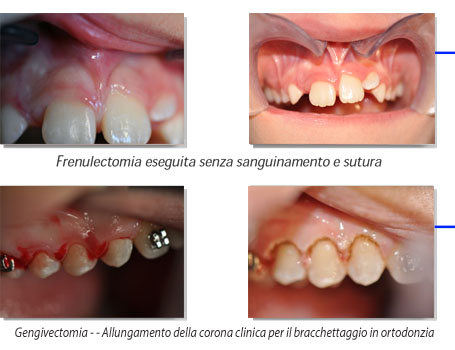 casi clinici laserterapia