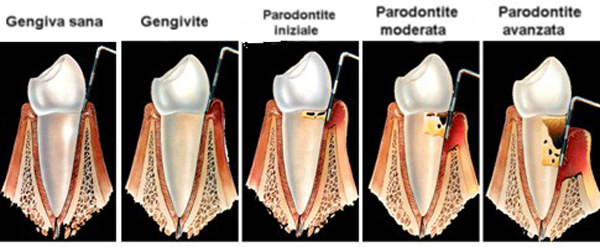 evolutione-parodont1